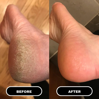 PureFoot Relief Stick — 3